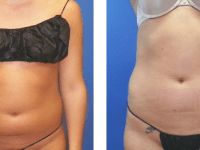 Smart Lipo - Abs