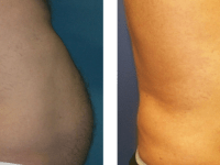 Smart Lipo - Abs