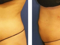 Smart Lipo - Abs