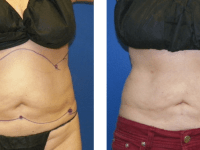 Smart Lipo - Abs