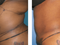Smart Lipo - Abs