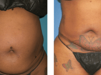 Smart Lipo - Abs