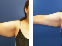 Smart Lipo - Arms