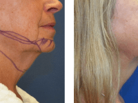 Smart Lipo - Chin