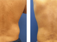 Smart Lipo - handles