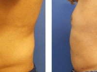 Smart Lipo - handles