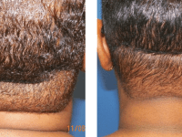 Smart Lipo - neck