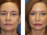 SmartSkin CO2 Fraxel SmartSkin CO2 Fraxel