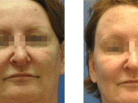 SmartSkin CO2 Fraxel