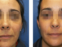 SmartSkin CO2 Fraxel
