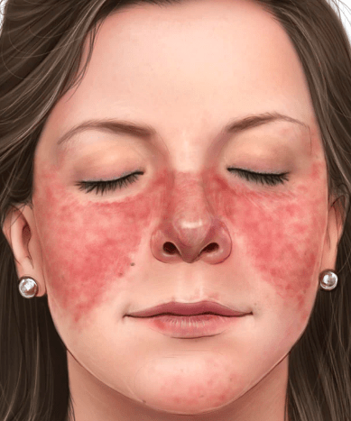 Lupus facial rash
