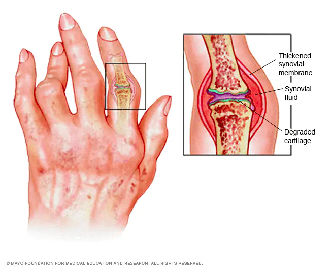 rheumatoid arthritis illustration